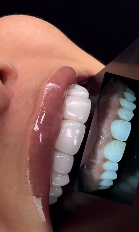 Lentes de Contato Dental — antes e depois